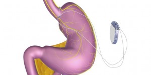Implant gastrique
