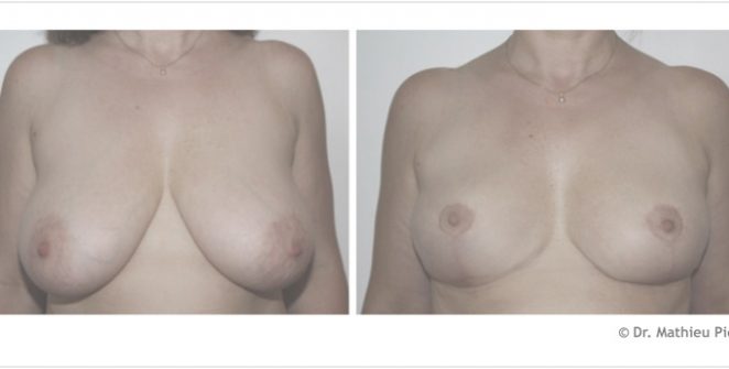 hypertrophie des seins tunisie