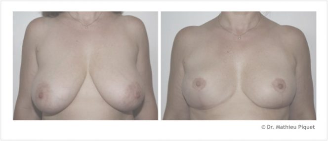 hypertrophie des seins tunisie