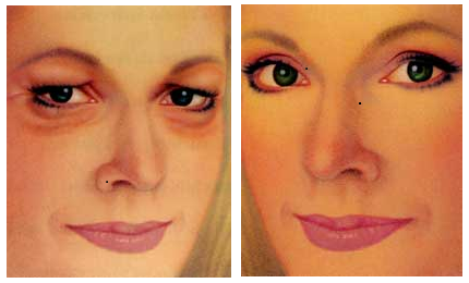 blépharoplastie