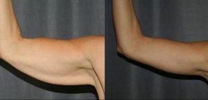lifting des bras