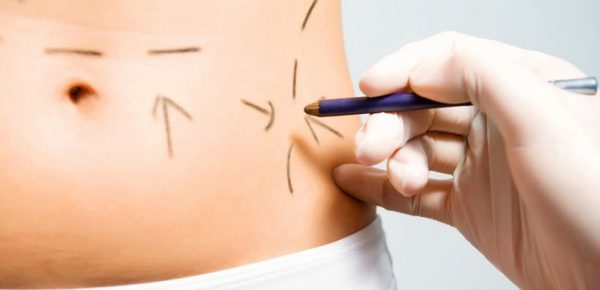 la liposculture