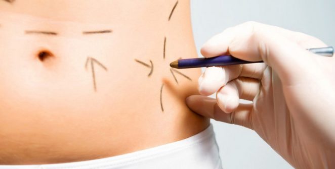la liposculture