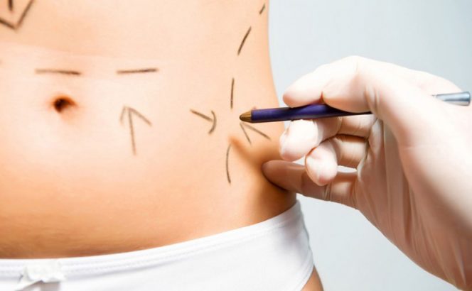 la liposculture