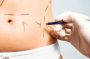 la liposculture